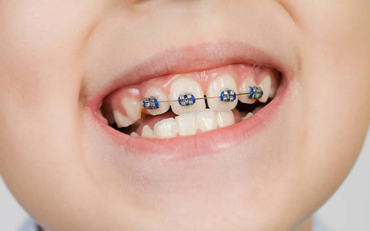 braces partial types teeth treatment orthodontics cost orthodontist torque